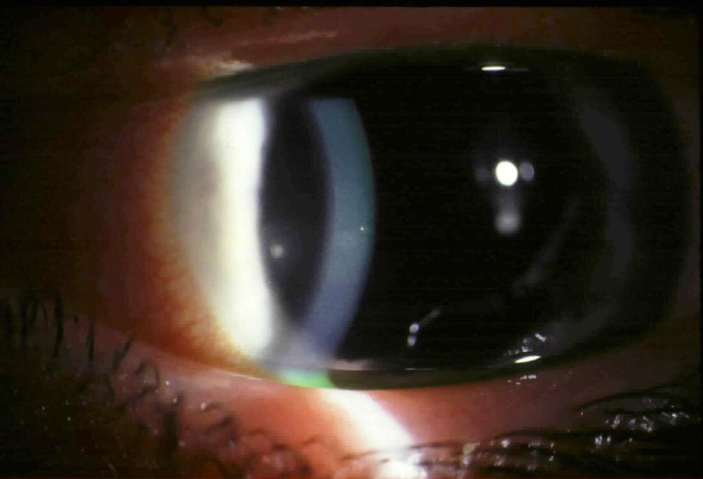 Iridocyclitis and HZO!Most common and most often overlooked ocular complication (43%)!