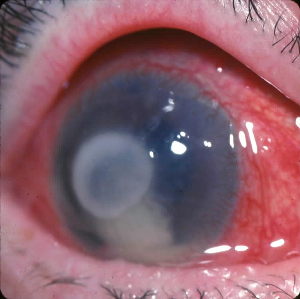 56% of patients developed glaucoma!! Seven Rules of Highly Effective Iritis Management 1.