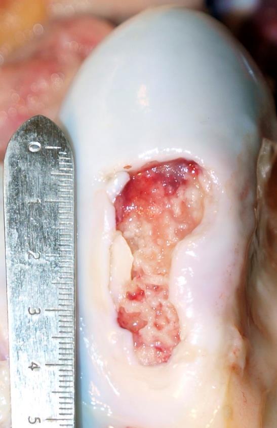 CASE #2 OCD OF THE TROCHLEAR RIDGE FEMOROPATELLAR JOINT OCD (osteochondritis dissecans) is an abnormality in bone growth (endochondral ossification) affecting young horses.