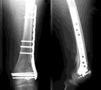 Distal Femur Fractures: Tips and Tricks for Plating and Nailing?