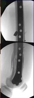 Early healing Fewer bone grafts Lessen infection risk Mast et al.