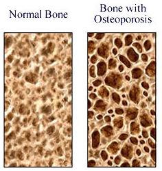 Metabolic & Endocrine disorders of bone: Osteoporosis: Bone apposition <