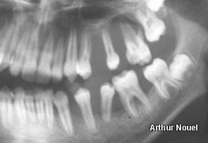 long bones, Mand>Max Jaws: localized bone destruction w swelling & often pain Rx: floating in