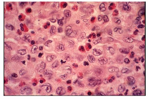 Histiocytes w pale, lobulated nuclei & eosinophilic cytoplasm Eosinophils, neutrophils, lymphocytes He,