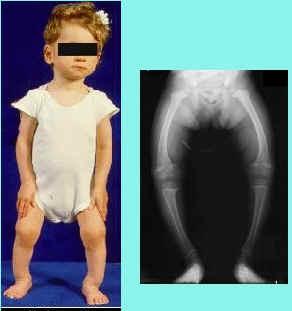 Rickets & Osteomalacia: Rickets & Osteomalacia: o Vit D or resistance to its action o RF, malabsorption
