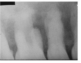 resorption Haemorrhage Infection o Rx: Diffuse radcy Patchy Osteosclerosis cotton