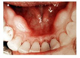 multiple-lobed Tongue movement, denture, O.