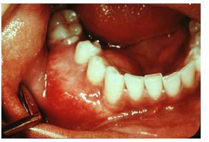 Loosening of teeth, paraesthesia Trismus Nasal obstruction & eye