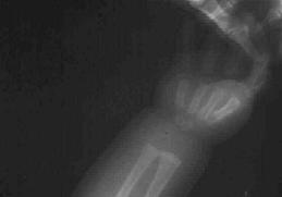 treatment Use and update on new evidence base Osteomyelitis CONTENT Septic Arthritis Case Male 3