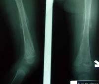 Osteomyelitis : Clinical Features Early acute 2/3 >Febrile Avoid using the extremity,limps, pseudoparalysis localize