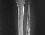 Osteomyelitis:X ray Acute osteomyelitis:special studies Bone