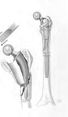 PERIPROSTHETIC FEMUR FRACTURES: Vancouver B 2 /B 3 Bypass fracture with fluted tapered stem