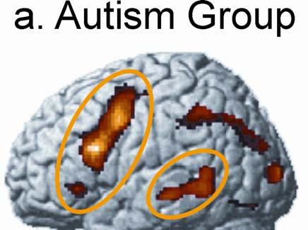 Brain activation during sentence comprehension in autism