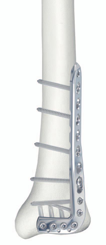 LCP Anterolateral Distal Tibia Plate 3.5. The low profile anatomic fixation system with optimal plate placement and angular stability. Overview The LCP Anterolateral Distal Tibia Plate 3.