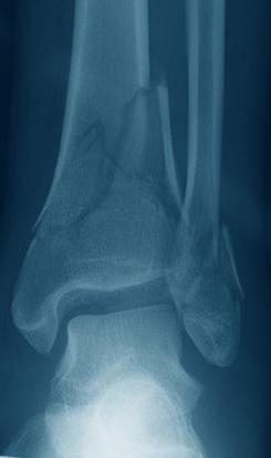tibia fractures Distal tibia fracture, percutaneous or reducible by