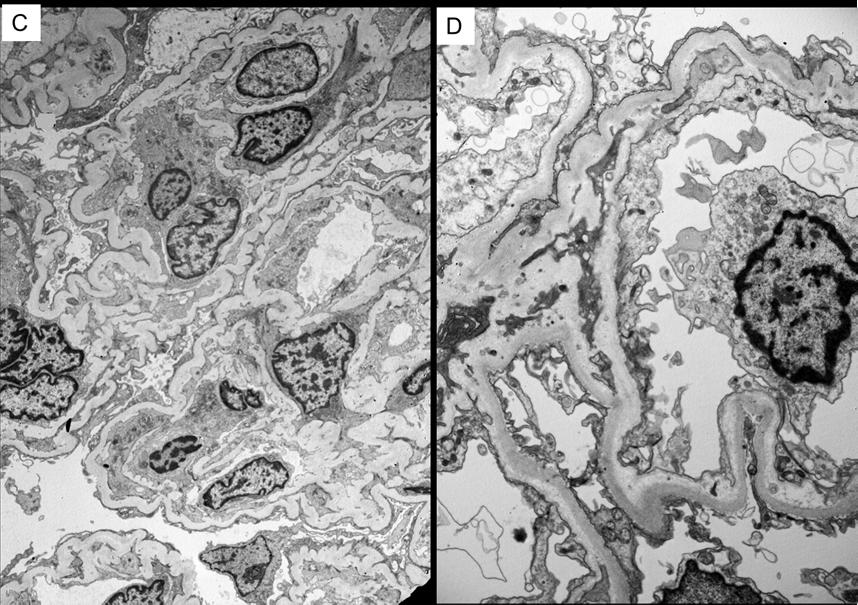 GBM duplication Subendothelial lucency Electron microscopy Features of glomerular microangiopathy in 8/20 (40%) Absence of electron-dense immune complextype deposits Absence of finely granular