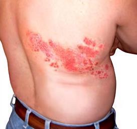 Herpes Zoster (Shingles) Post-herpetic Neuralgia (>3months) Severe nerve