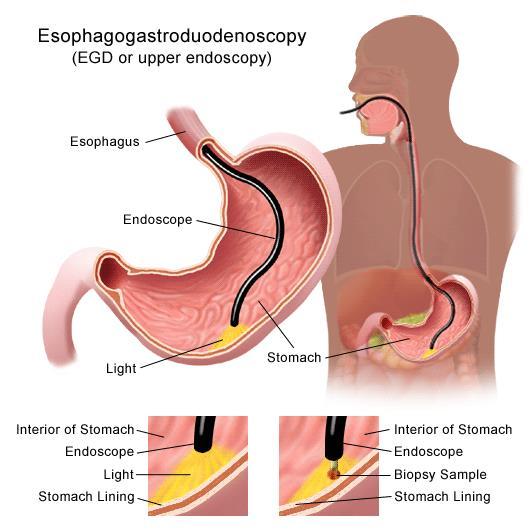 Standard procedure - Esophagus stomach duodenal bulb 2 nd part