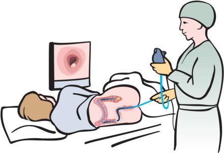 Colonoscopy Using pediatric colonoscope or adult colonoscope Advance to proximal to splenic flexure Goal : 1.