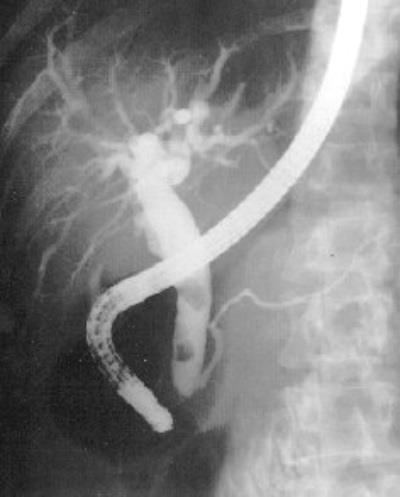 Endoscopic retrograde cholangiopancreatography (ERCP) Examination of bile duct and pancreatic