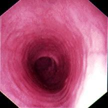 sphincter (LES) *Most common endoscopic report using