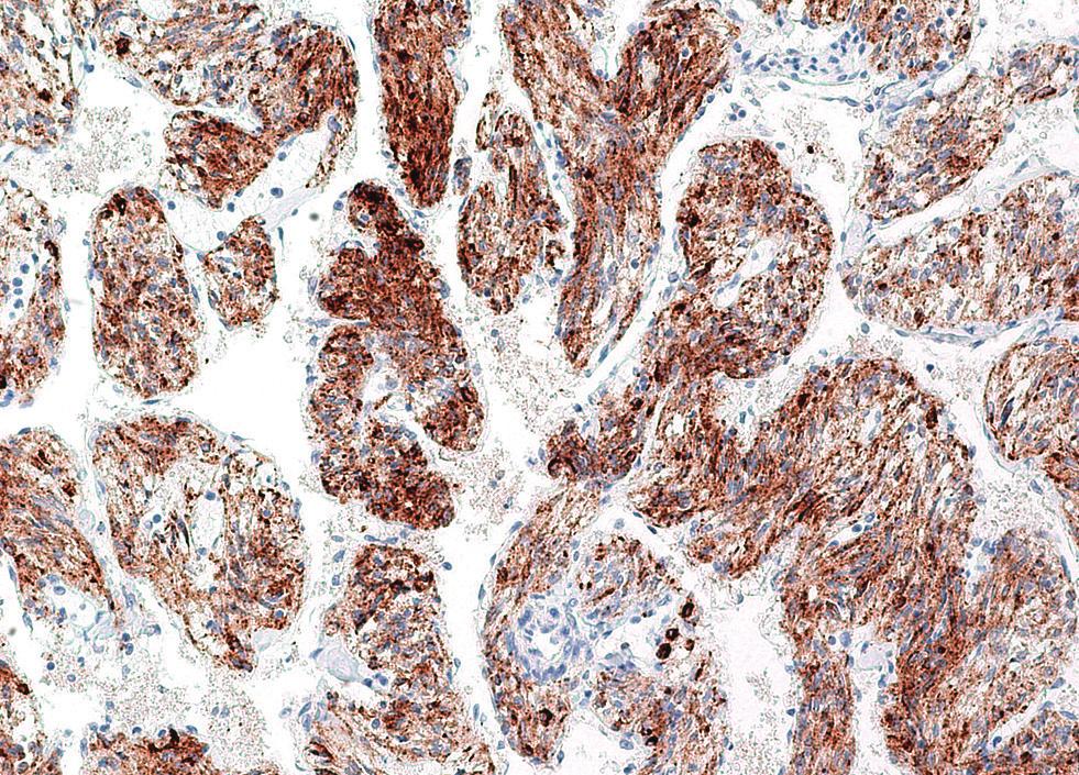 Multiple well-defined, uniformly thin-walled cysts are observed diffusely distributed throughout both lungs.