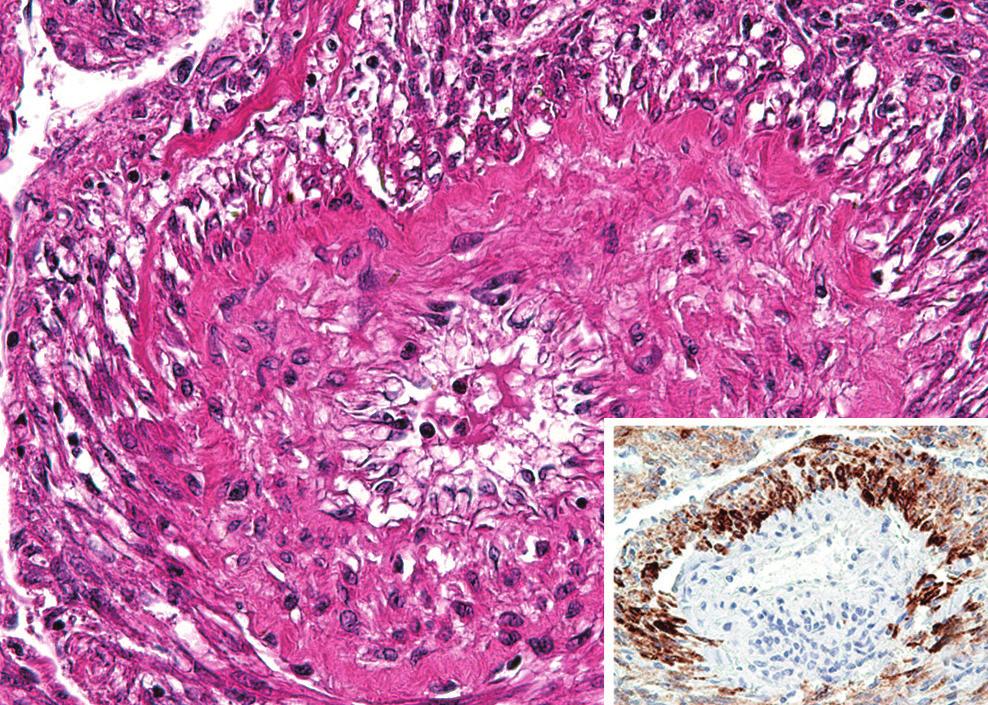 (F) Perivascular epithelioid E-LAM (PEE) cell proliferation detected at the intratumoral area of case no. 2.