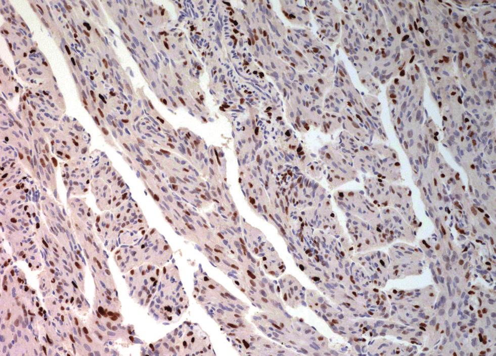 (inset) (G) Positive staining for HMB-45 in spindle tumor cells (case no. 2).