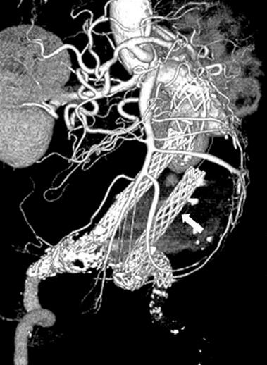Preoperative CT angiography (A, B) and the explanted stent graft (C) in patient 2.