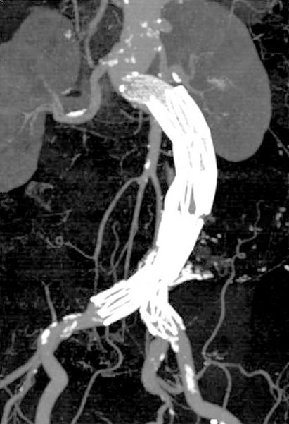 arteries. In situ aortic reconstruction using a bifurcated PTFE graft was performed.