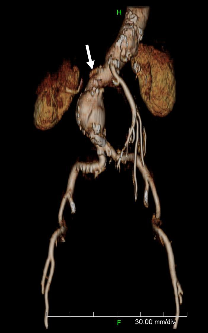 shows a 5.1-cm infrarenal aortic aneurysm (arrowheads). Figure 6: Eighty-one-year-old woman with infrarenal aortic aneurysm.