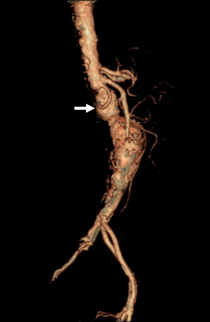 Axial CT in arterial phase (CTA) with use of 100 ml of Omnipaque 350 intravenous contrast injected at a rate of 4 ml/s shows a 5-cm infrarenal