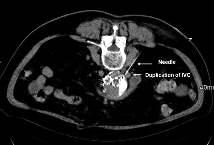 Needle placement using a right-sided CT-guided approach through the retroperitoneum