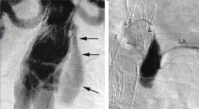 Type I Endoleak Type I endoleak is caused by failure to achieve a circumferential seal at either the proximal (Type IA) or distal end (Type IB) of the stentgraft.