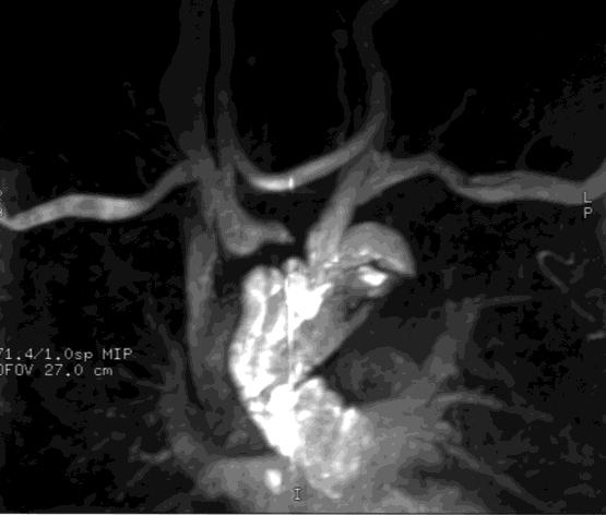 Aortic BYPASS OCCLUSION 72 yo male patient with a residual arch dissecting aneurysm 2 years