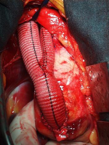 Underwent a redo CPB for aortic valve replacement & concomitant total arch transposition.