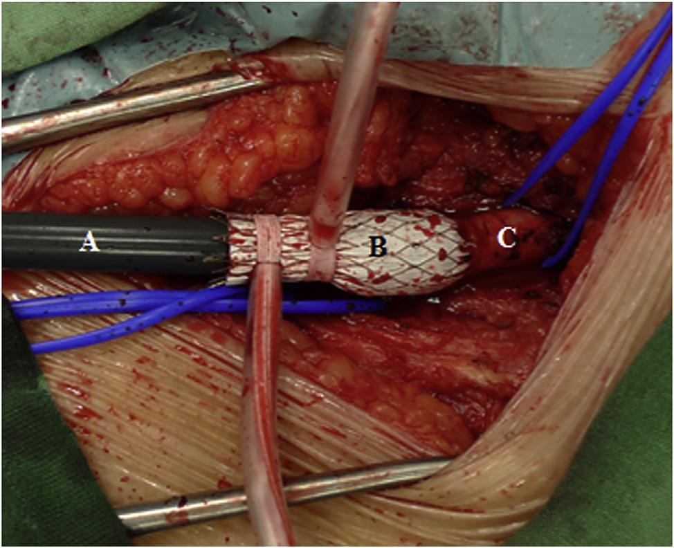 Endoconduits with Pave and Crack Technique Avoid Open Ilio-femoral Conduits with Sustainable