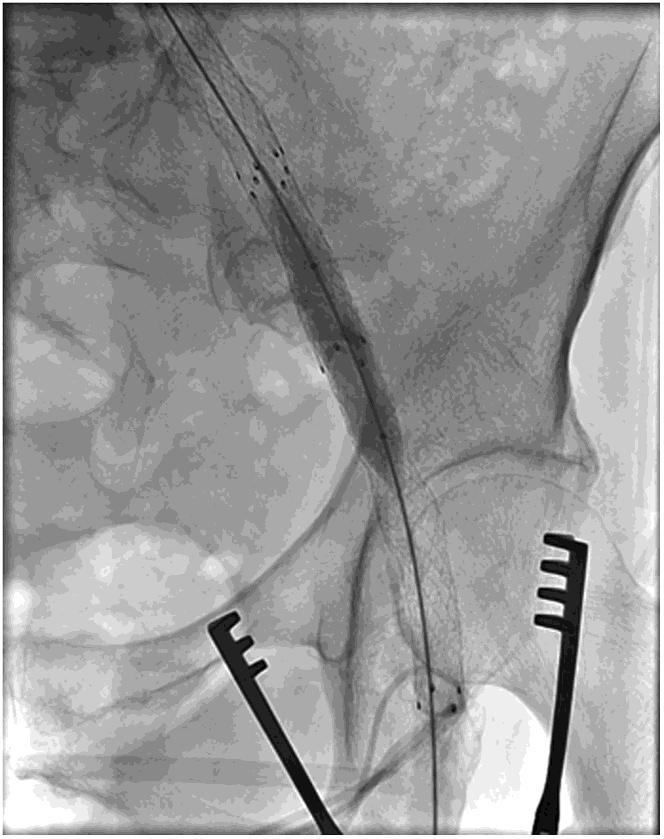 Endoconduits with Pave and Crack Technique Avoid Open Ilio-femoral Conduits with Sustainable Mid-term Results G.
