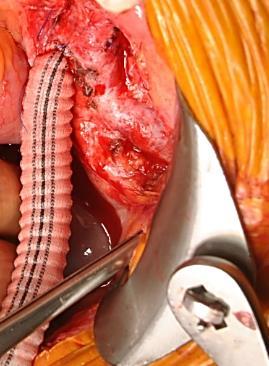 iliac artery - external