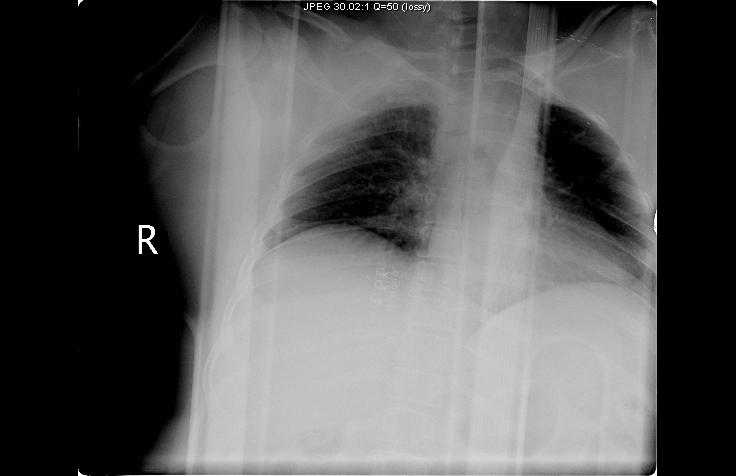 aortic knob obliteration opacification of the aortopulmonary window