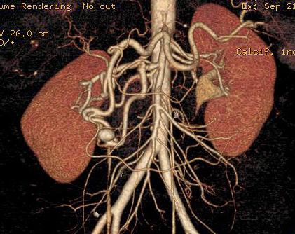 PDA ANEURYSM Focal saccular aneurysm of an hypertrophied pancreatico duodenal artery is usually related to Takayasu