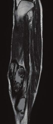 T1-weighted image (axial) Figure 2: MRI revealed that the mass exhibited heterogeneous signals on T1- and T2-weighted