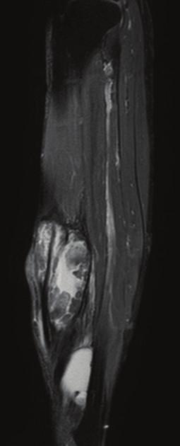 Fat suppressed gadolinium-enhanced T1-weighted images revealed slight heterogeneous enhancement within the affected