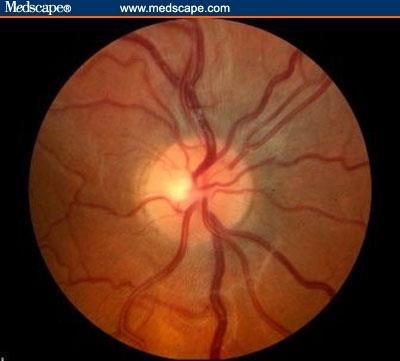 Disease of the optic nerve, resulting in ganglion cell death,