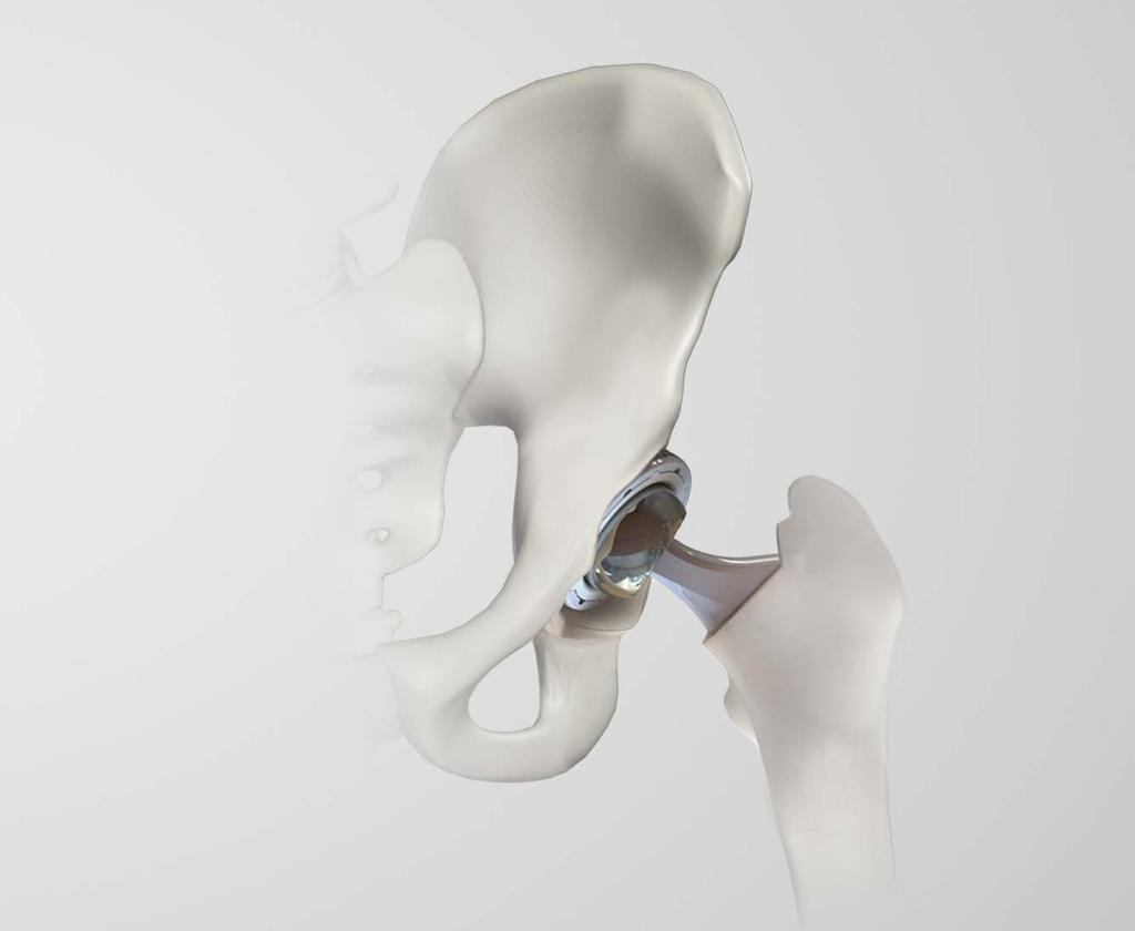 Implant insertion Insert the appropriate acetabular liner. Introduce the femoral stem into the canal by hand and fully seat the stem with the selected stem insertion instrument.
