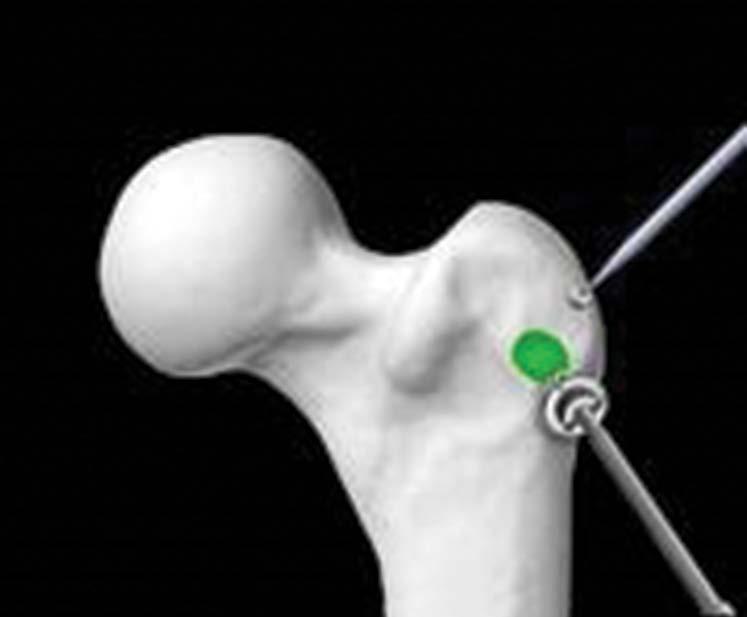 Femoral array screw placement and checkpoint Locate the proper placement for the femoral cortical screw and prepare the surface by clearing all soft tissues.