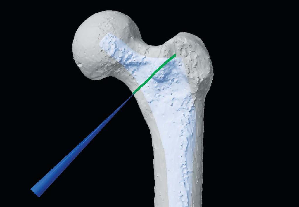 Figure 32 Guided femoral neck resection In the enhanced femoral workflow, the surgeon has access to a guided neck resection.