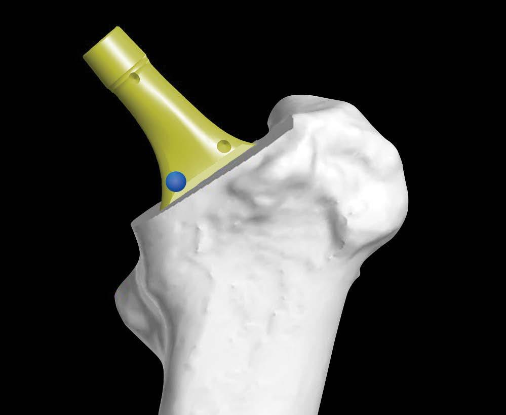 Broach tracking Attach the appropriate divoted neck trial that corresponds to the planned femoral implant and selected neck option, reattach the femoral array and collect the three points on the