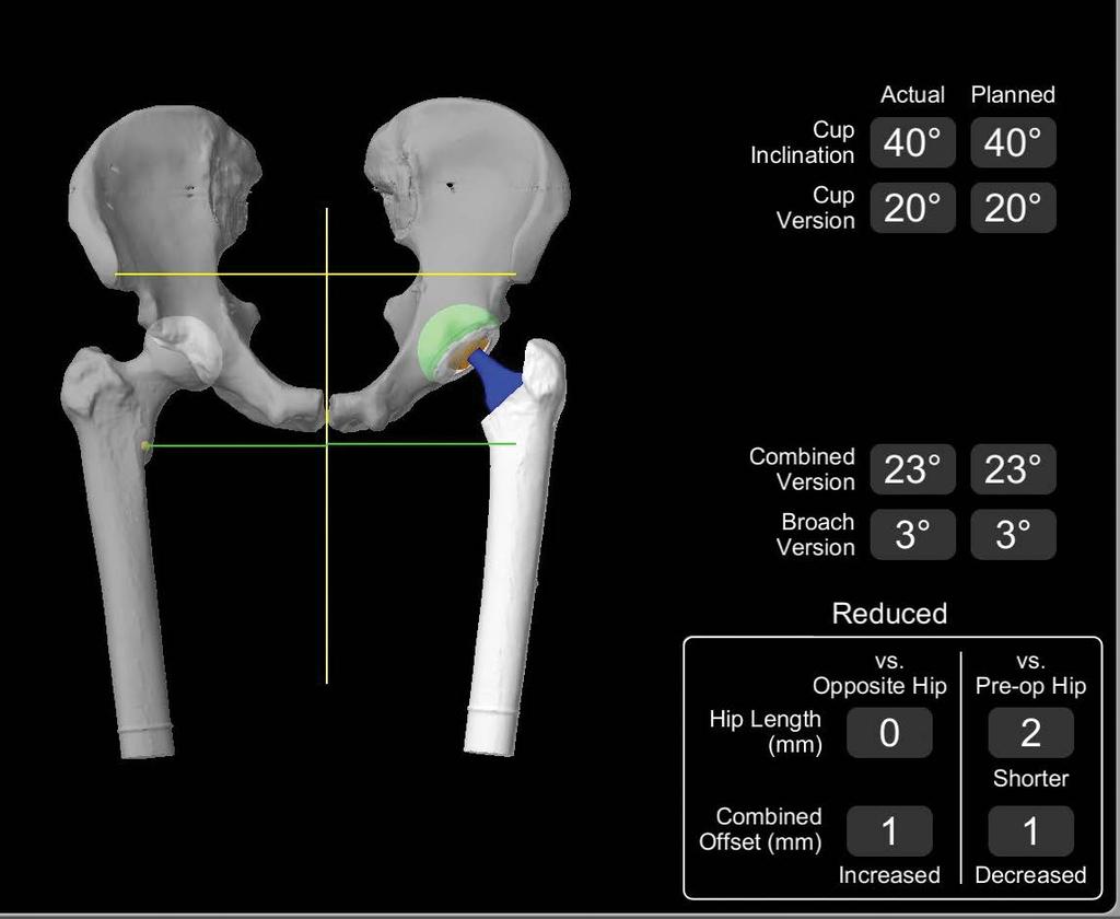 Enhanced femoral workflow reduction results Once the hip is reduced, reattach the femoral array.