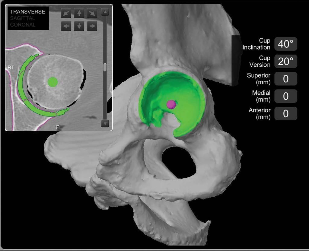 Acetabular shell planning The coronal view can also be shown in x-ray mode by selecting x-ray view in the software (figure 4).